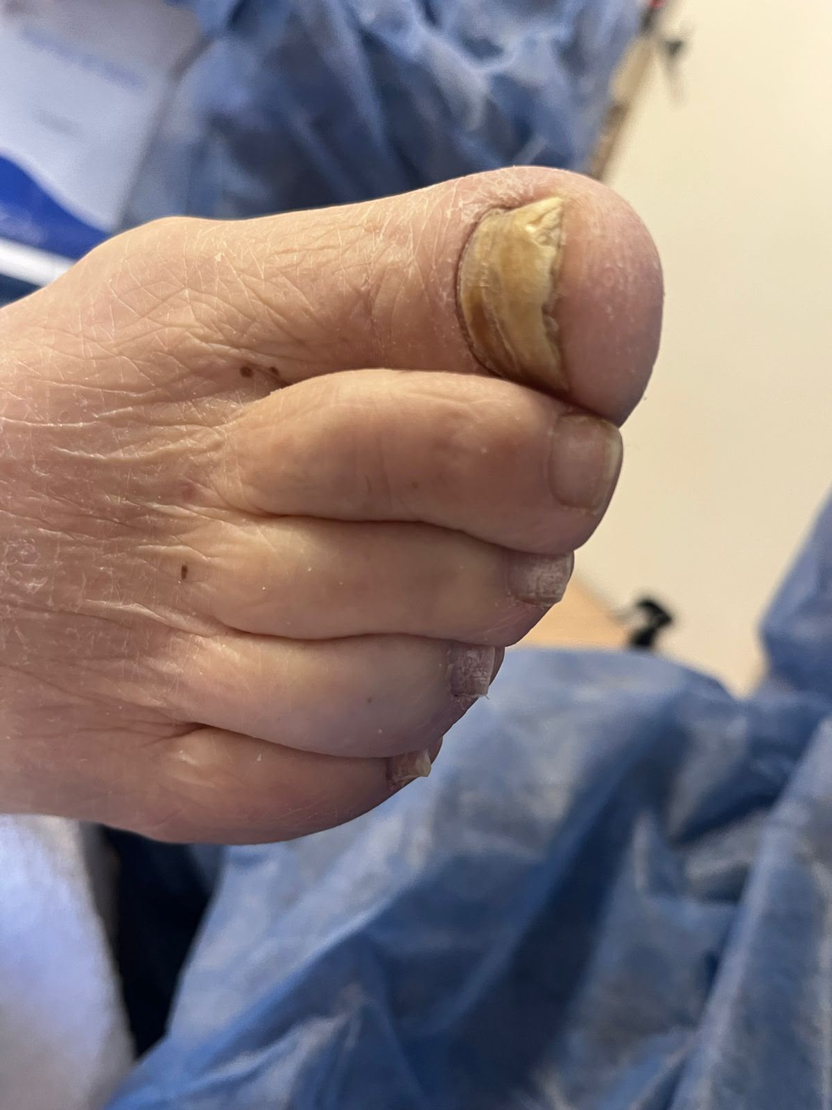 Estado del pie antes del servicio de pedicuría