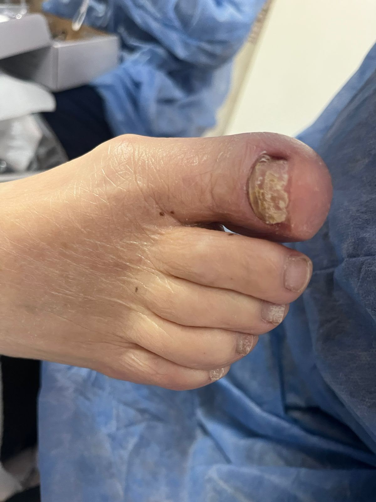 Resultado del pie después del servicio de pedicuría