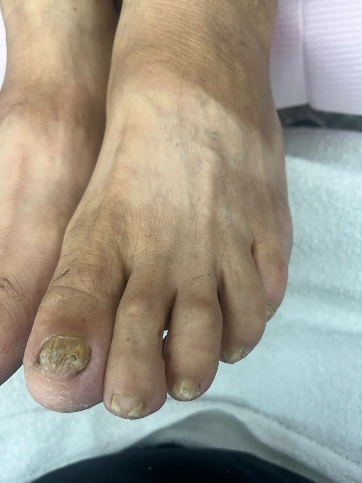 Estado del pie antes del segundo servicio de pedicuría