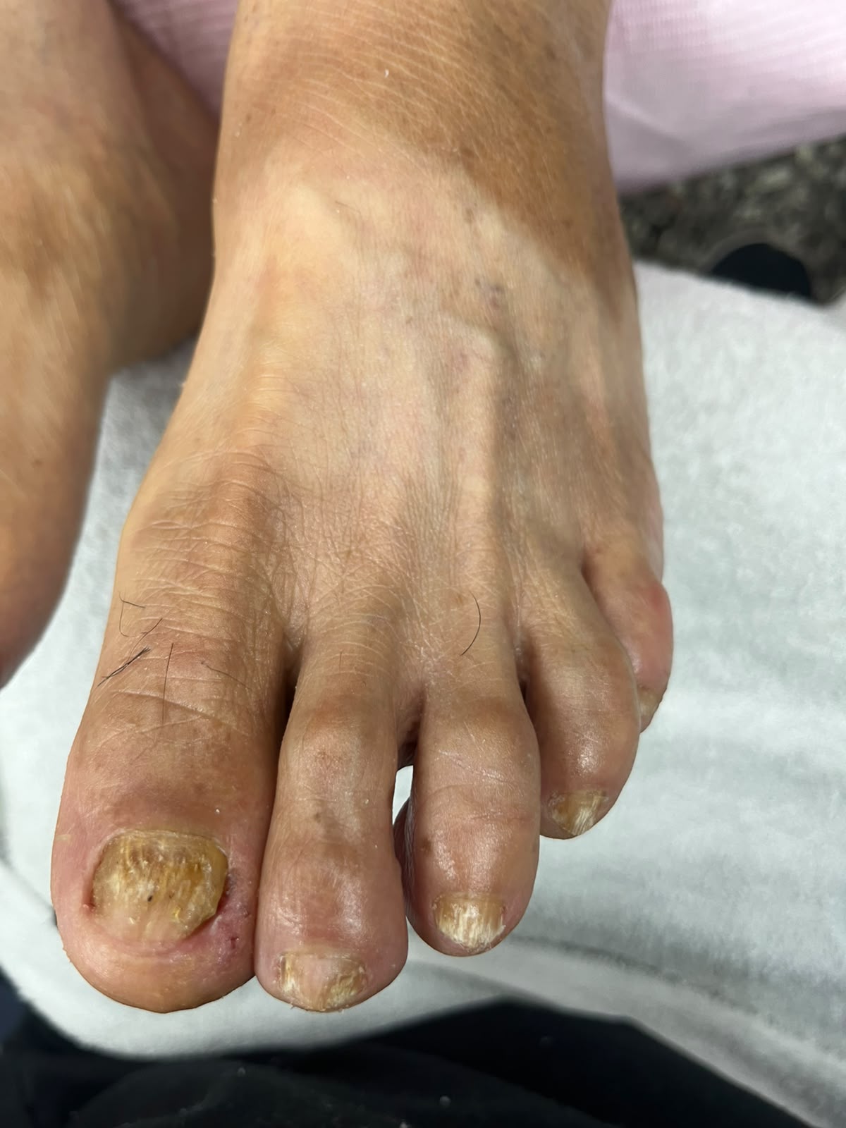 Resultado del pie después del segundo servicio de pedicuría